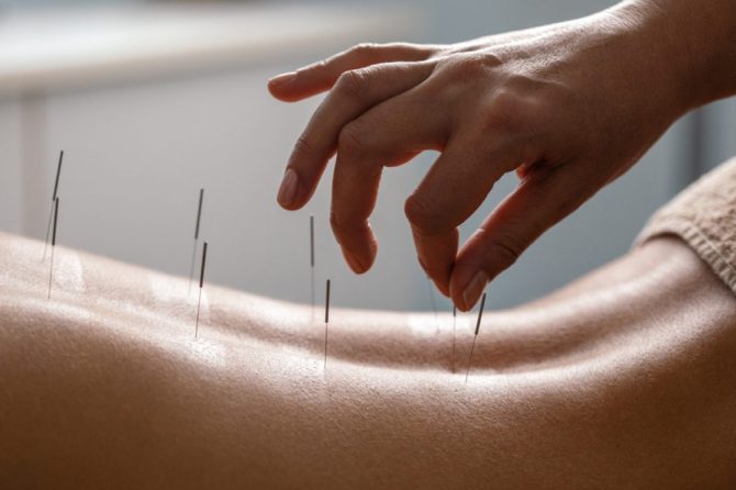 The truth about Acupuncture – ancient wisdom, modern relief
